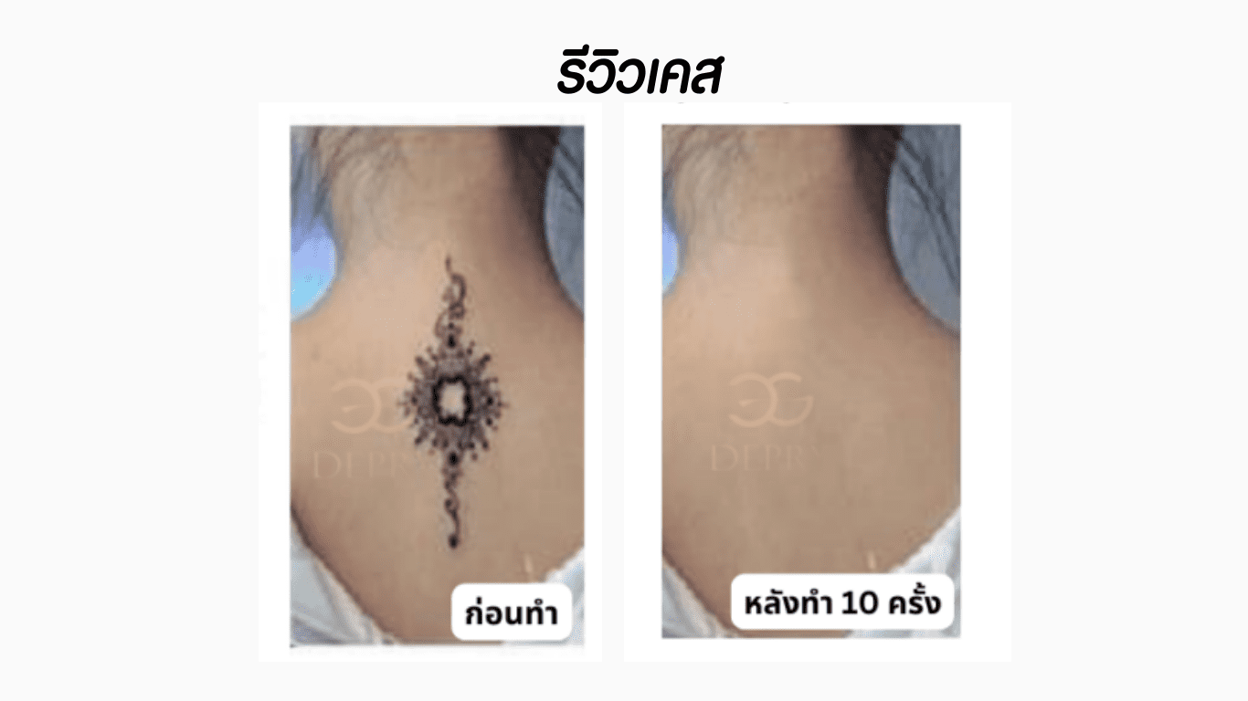 รอยสักหลังทำ Pico Laser 10 ครั้ง