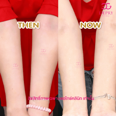 Neowhite dePryClinic พิษณุโลก ฉีดผิวพิษณุโลก