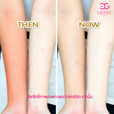 Neowhite dePryClinic พิษณุโลก ฉีดผิวพิษณุโลก