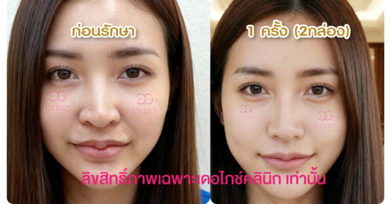 รีวิว Belluxi เคส 2