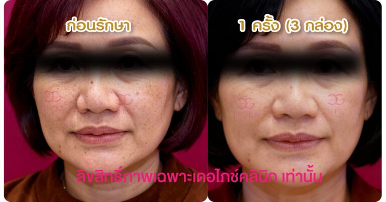 รีวิว Belluxi เคส 1