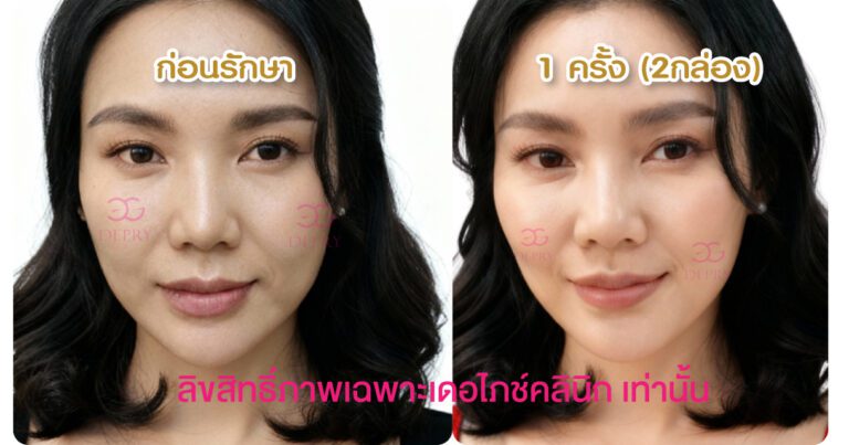 รีวิว Belluxi เคส 3